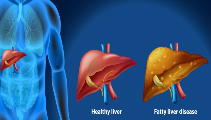 Fatty liver: फैटी लिवर के इन लक्षण को भूलकर भी न करें इग्नोर